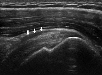 echografie-slijmbeursontsteking-schouder