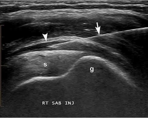 echogeleide-injectie-slijmbeursontsteking-schouder